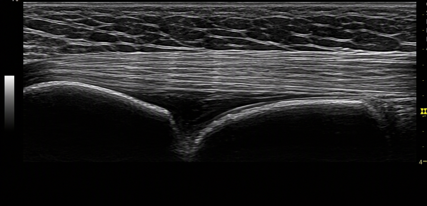 Ultrasonido diagnóstico de rodilla